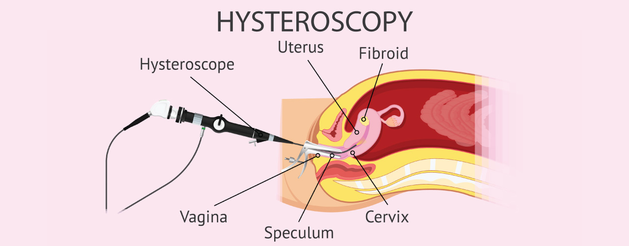 Hysteroscopy