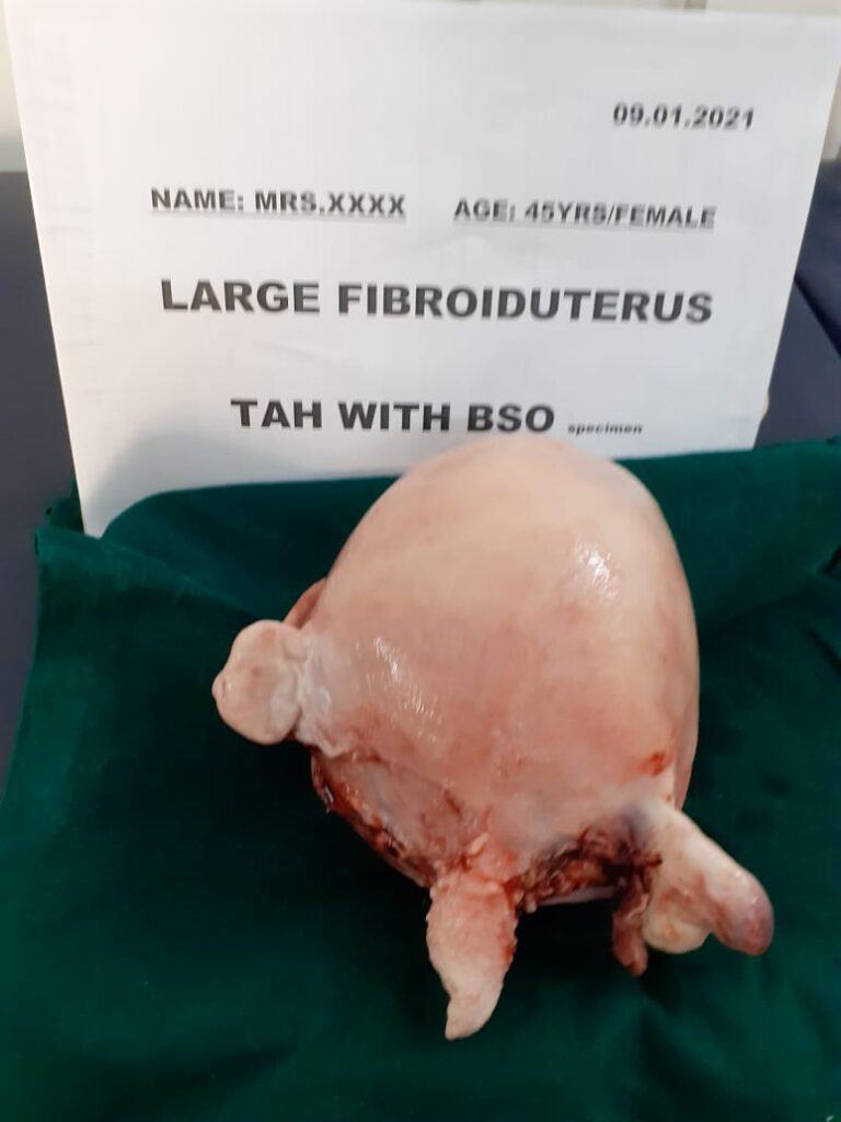 A middle-aged woman with chronic abdominal pain & heavy blood loss due to DUB - This is the reason big fibroid in the uterus