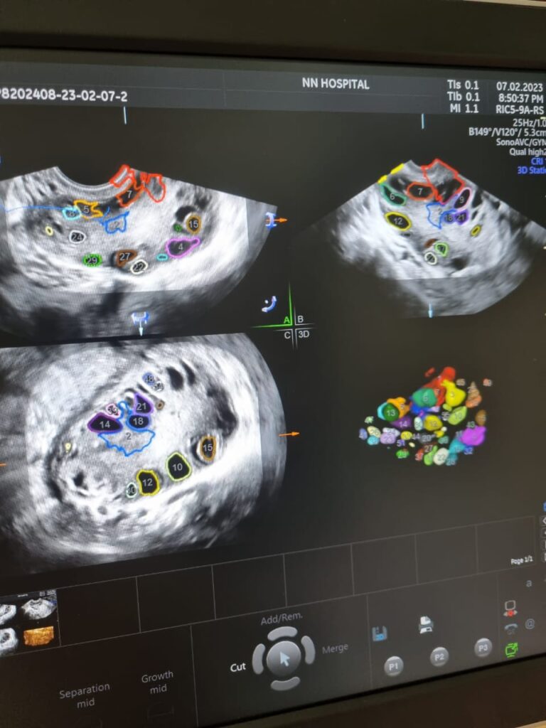 Demonstrating the value of USG imaging in a case of PCOS